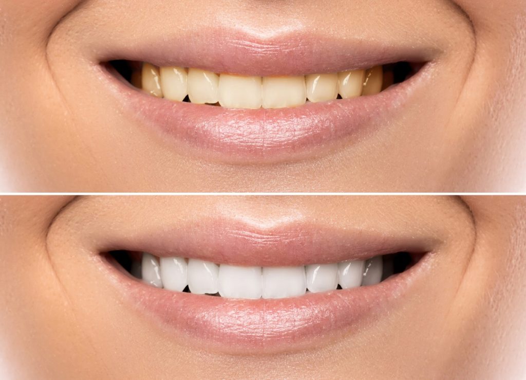 get a dazzling smile with Nubeam
